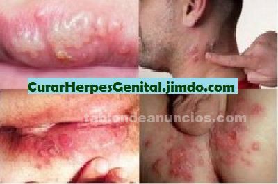 Como eliminar herpes con tratamiento natural Como eliminar herpes con tratamiento natural