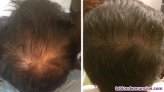 Fotos del anuncio: Laser dome 110 laser. Terapia laser alopecia. Aga.