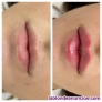 Fotos del anuncio: Aumento de labios 