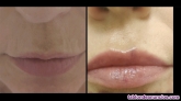 Fotos del anuncio: Aumento  hidratacin de labios